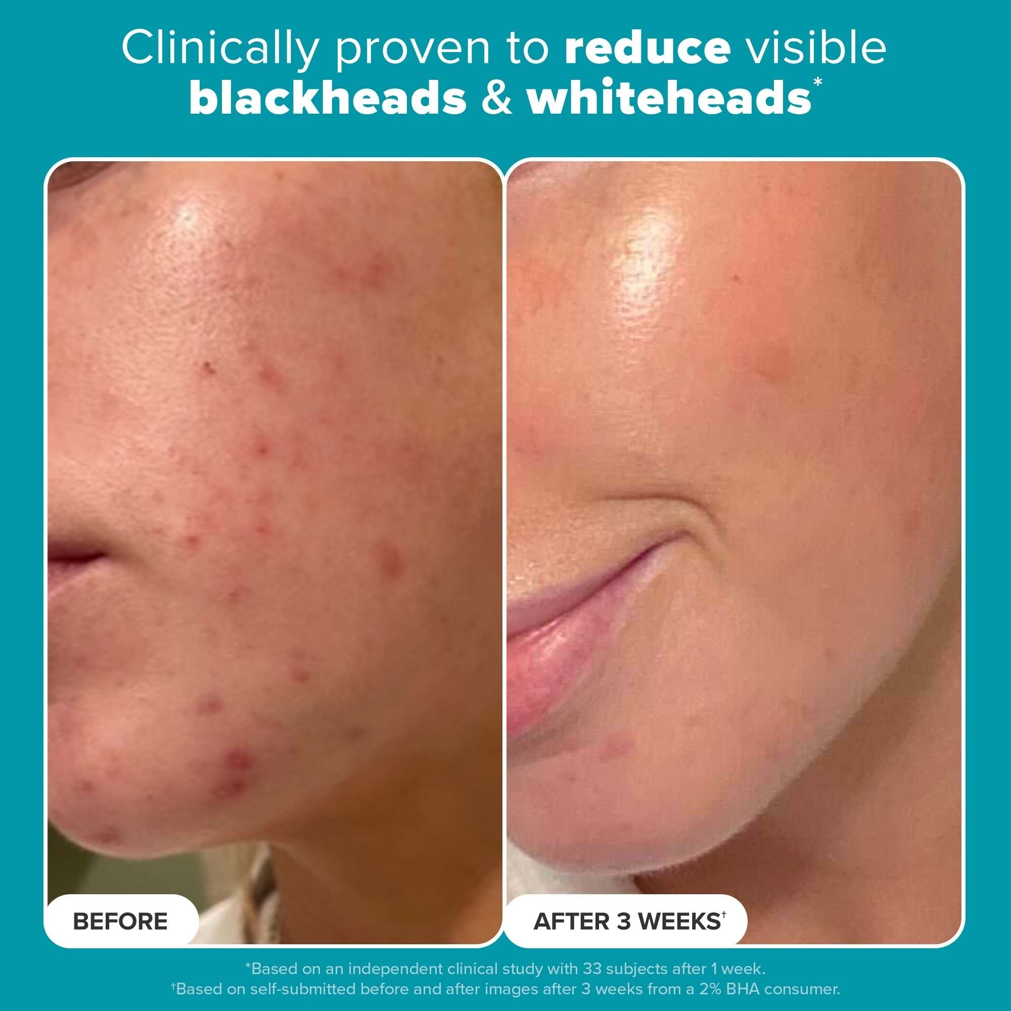 PAULA’S CHOICE 2% BHA Liquid Exfoliant